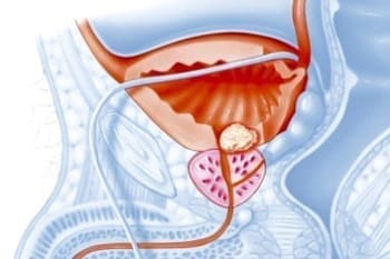 Prostatitis image